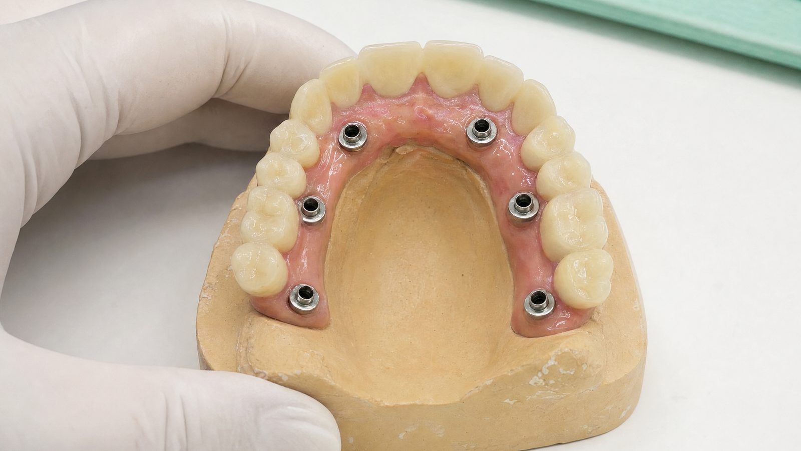 All-on-6 implant tedavisi ve All-on-4 ile farkı